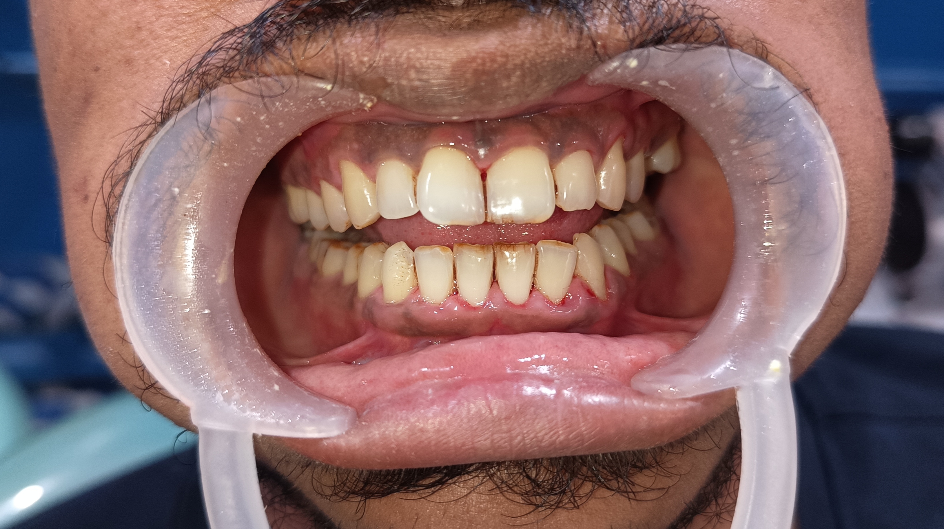 After Tooth Extraction