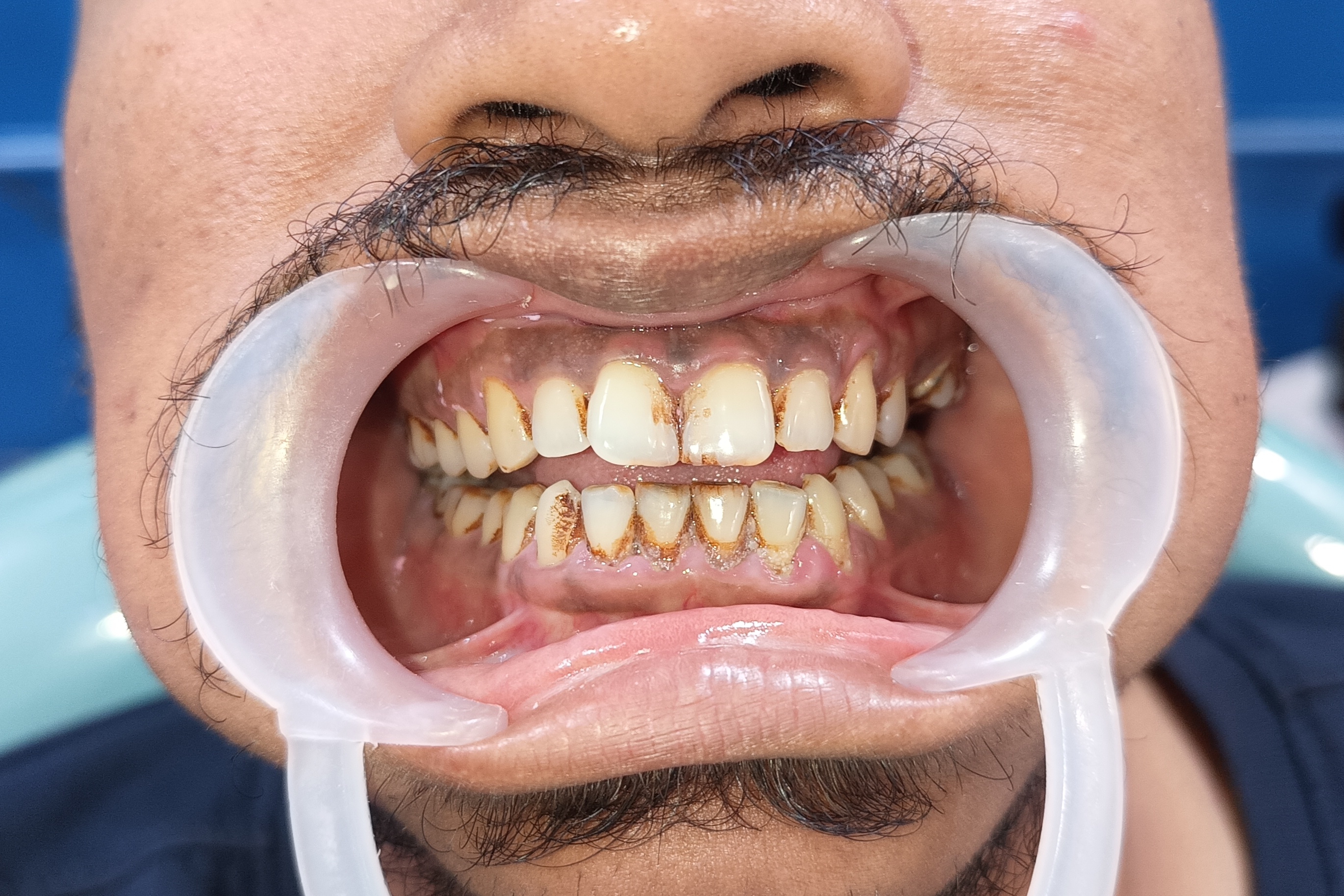 Before Tooth Extraction