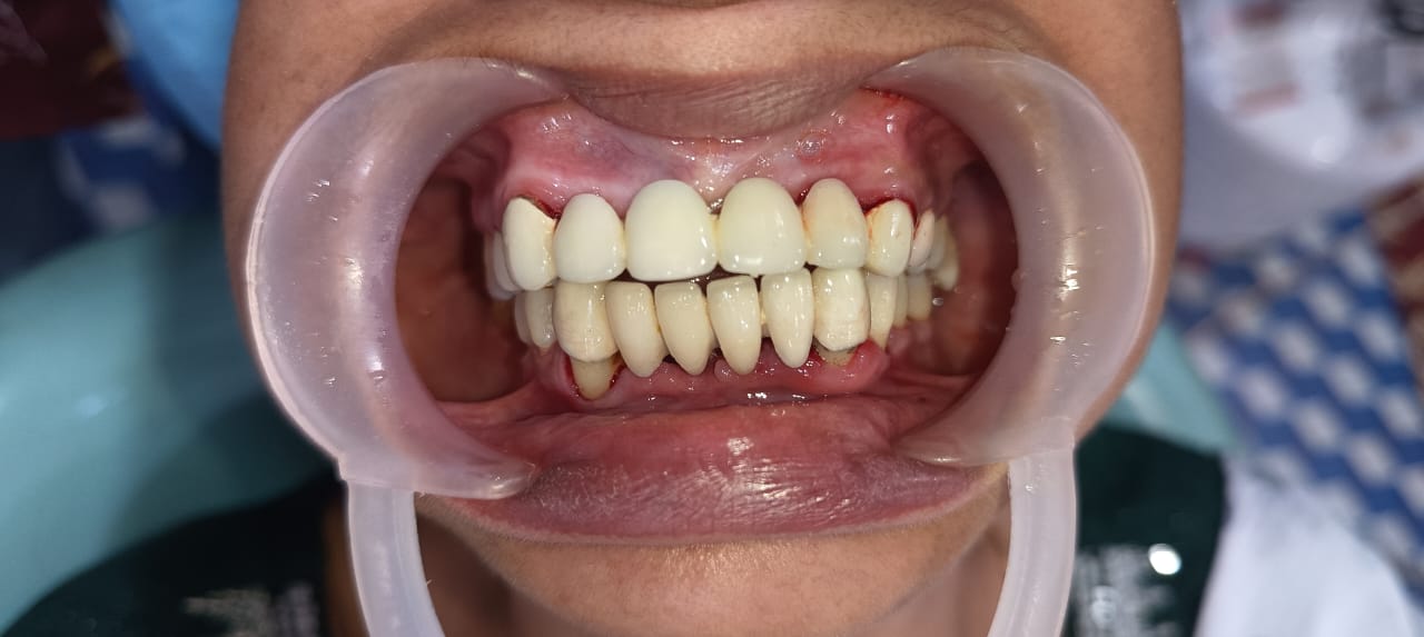 Before Tooth Extraction