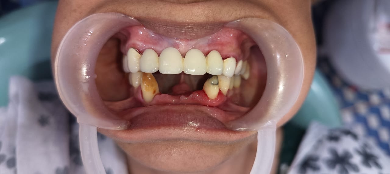 Before Tooth Extraction