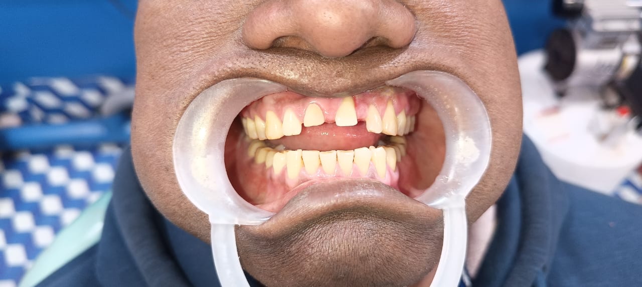 Before Tooth Extraction