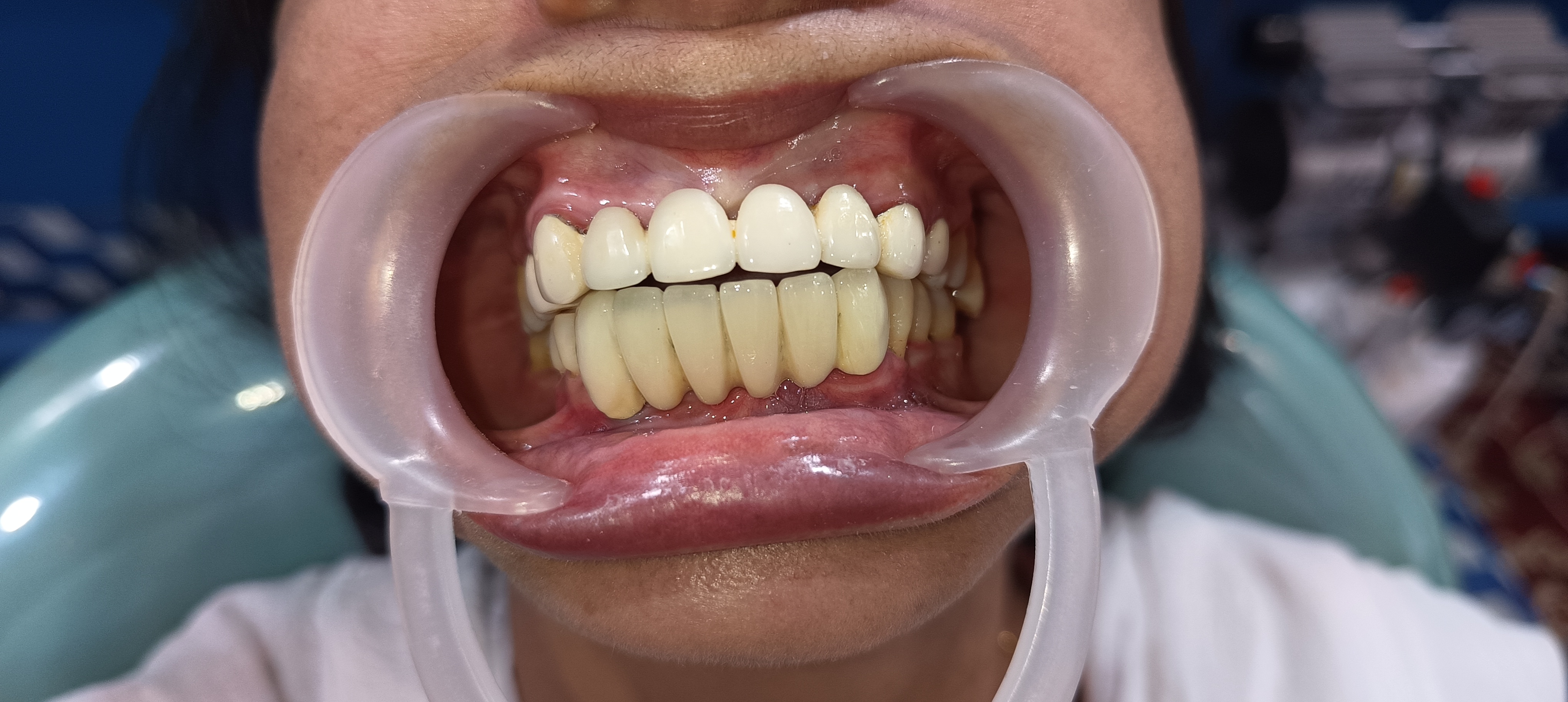 After Tooth Extraction