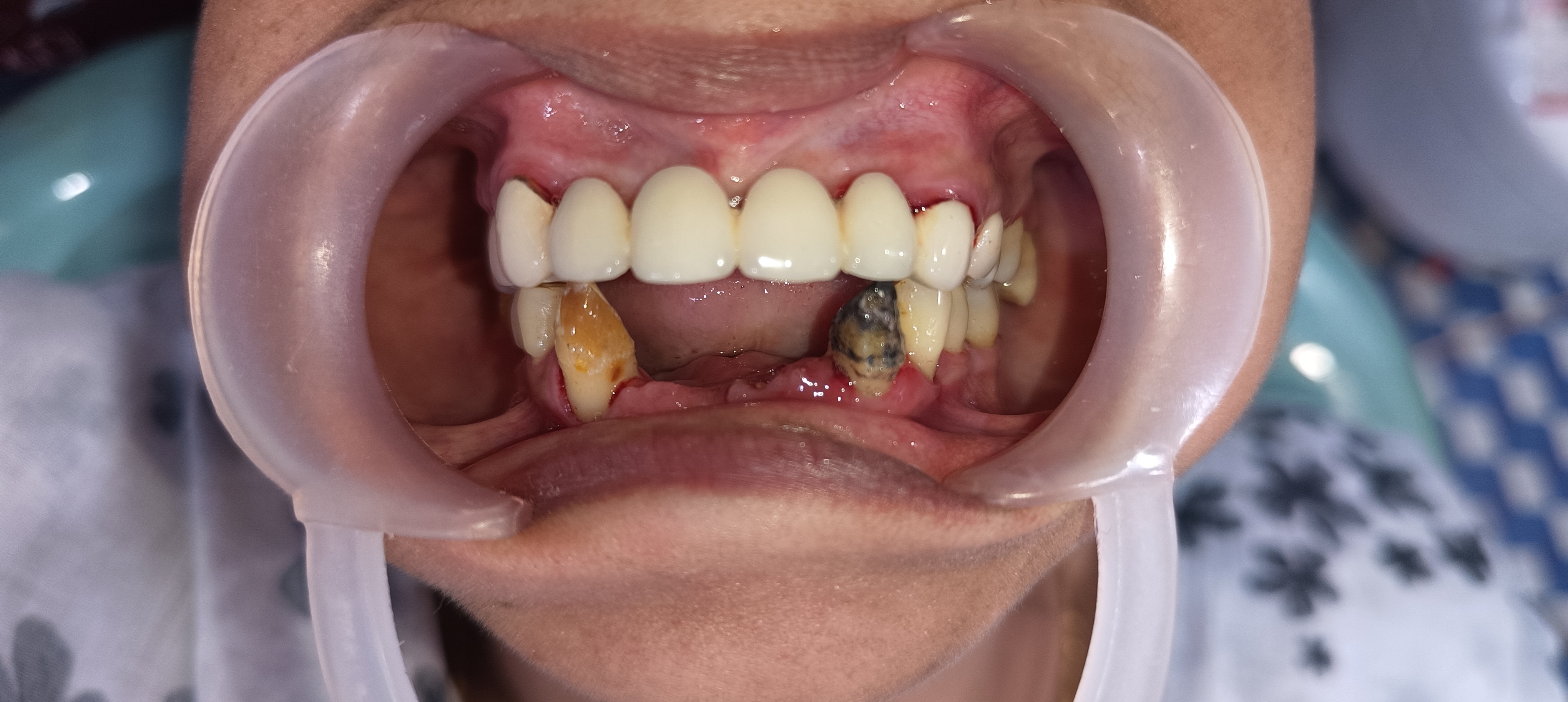 Before Tooth Extraction