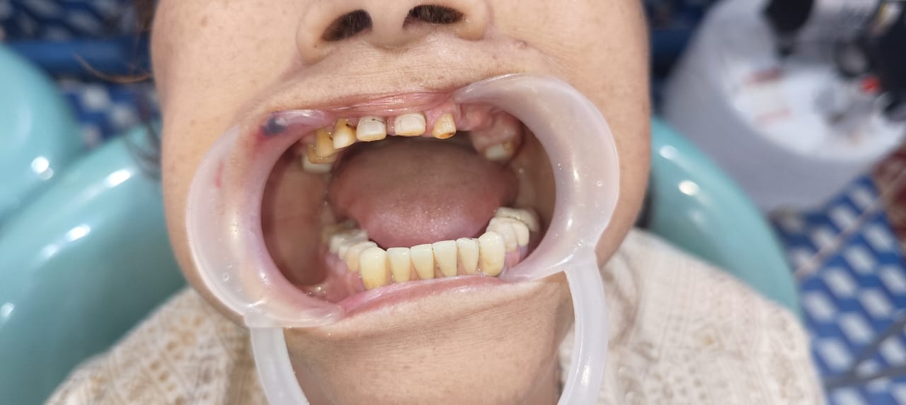 Before Tooth Extraction