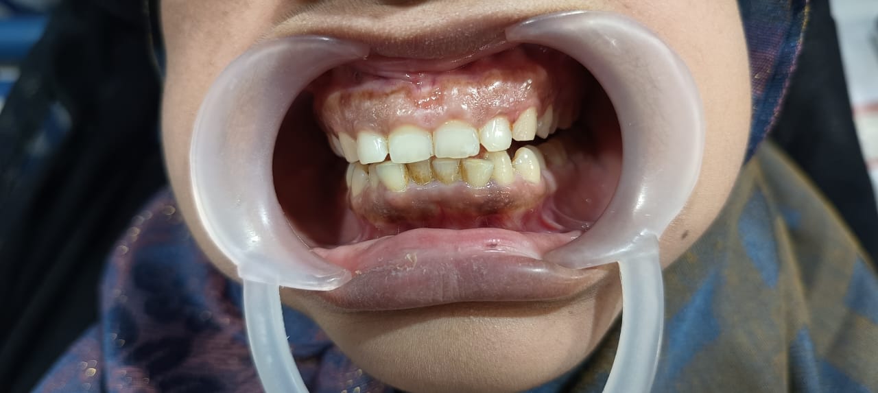 Before Tooth Extraction