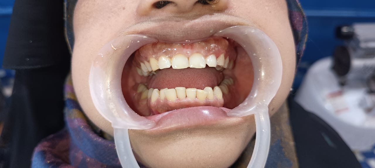 After Tooth Extraction